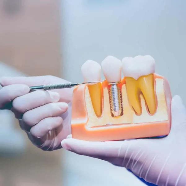Regaining Confidence Through Advanced Dental Implant Treatments